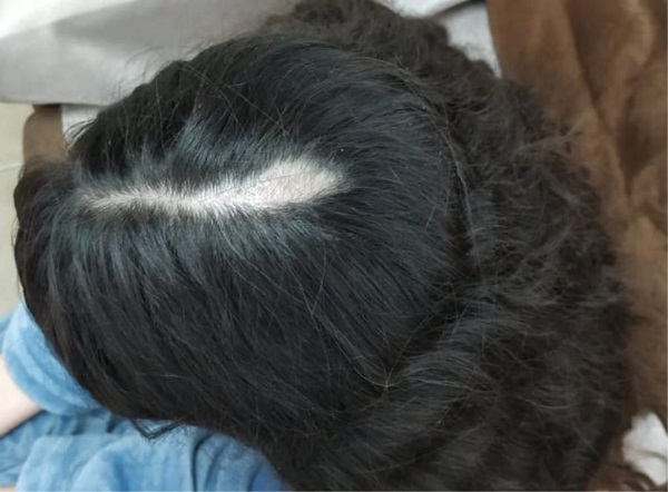 קווצת שיער נתלשה מראשה של דוגמנית השיער  דוגמנית שיער תובעת מיליון שקלים מחברת הפקות מנתניה
